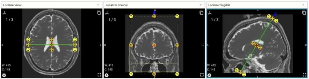 mri slice extraction