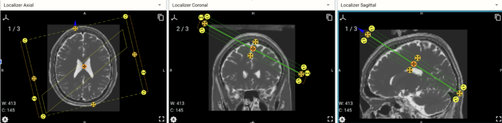 mri slice extraction